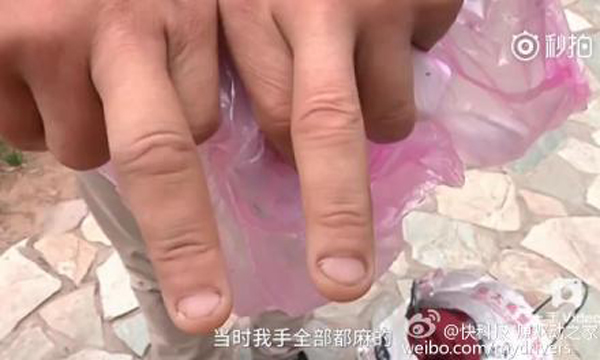 男子手部和臉部不同程度被炸傷。