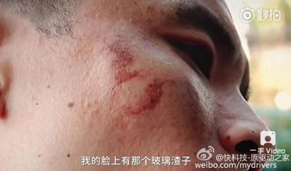 男子手部和臉部不同程度被炸傷。